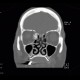 Osteoma of lamina papyracea: CT - Computed tomography